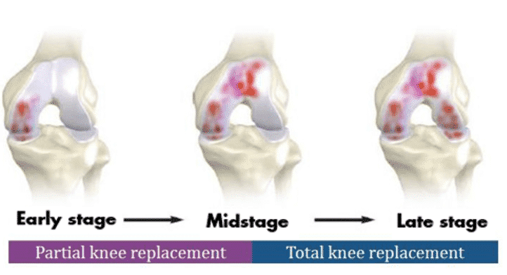 total knee vs partial knee diagram of the procedure